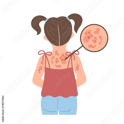 Allergic itching, skin inflammation, redness and irritation. A child with allergies. Healthcare and medicine. Vector