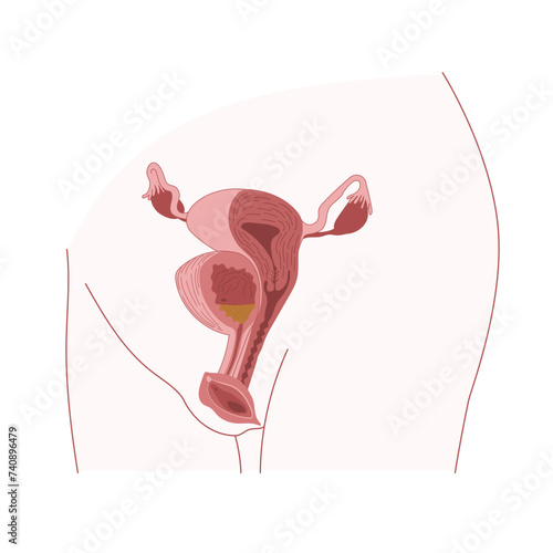 Human uterus and bladder shown on woman body. Vulva with urethra and clitoris.