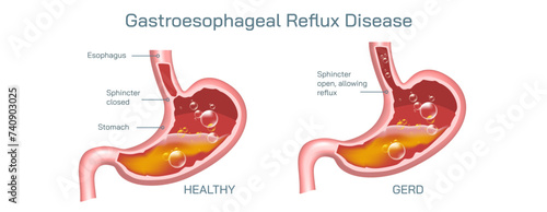 Stomach Gerd or Gastroesophageal reflux disease. Common Digestive Disorders. Poor Digestive conditions. How right medication keeps your stomach healthy. Student biology study material images.