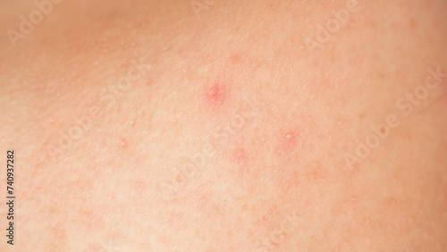 Problem skin with acne. close-up of a body part. photo