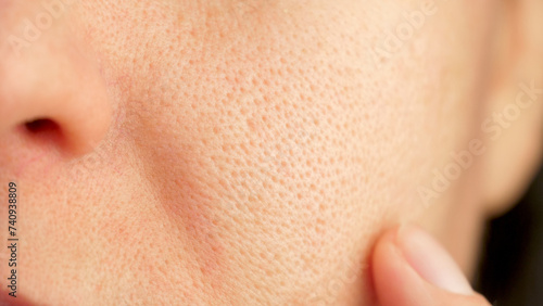 skin texture with enlarged pores. Problem skin. part of a woman face. acne. skin, pore, face, dry, acne photo
