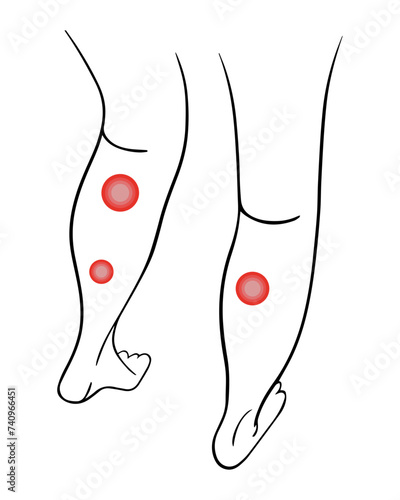 Varicose veins of the legs. Treatment of varicose veins.