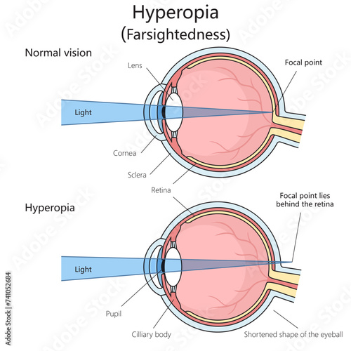 Farsightedness hypermetropia hyperopia structure diagram hand drawn schematic vector illustration. Medical science educational illustration