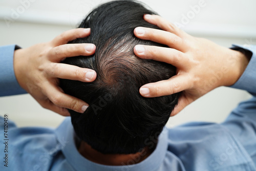 Bald head in man, hair loss treatment health problem. photo
