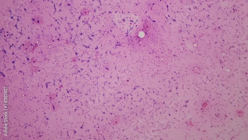 Semen. Qualitative and quantitative visual, physico-chemical and microscopic examination of male semen (ejaculate). 100x magnification. Oligozoospermia. Azoospermia
