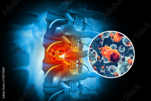 Spine cancer or spinal tumor disease.3d illustration
