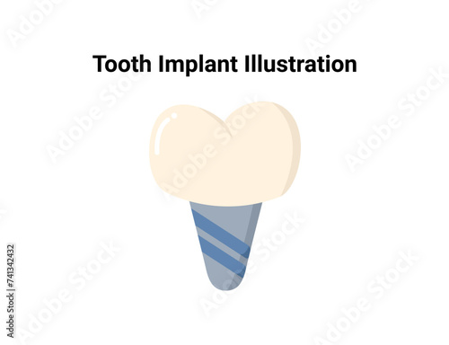 Tooth implant flat illustration. Dentistry and orthodontics vector illustration. Dental clinic services, stomatology, dentistry, orthodontics, oral health care and hygiene vector.