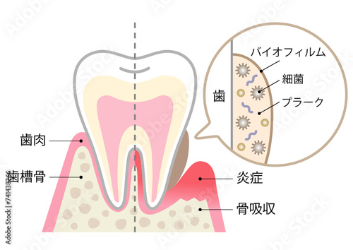 バイオフィルムと健康な歯