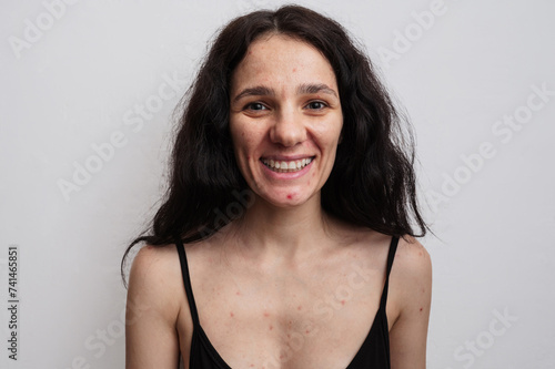 Фотография A large portrait of a young woman with skin problems - pimples, acne, enlarged pores