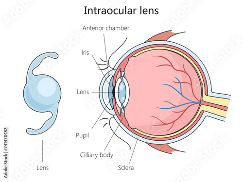 Intraocular lens structure diagram hand drawn schematic vector illustration. Medical science educational illustration