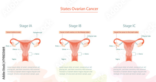 Ovarian Cancer Stages Infographic