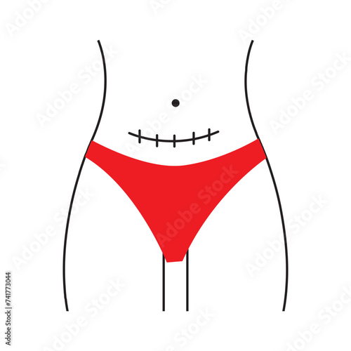 Scars line icon in vector, c-section scar illustration. Vector illustration . Isolated white background.