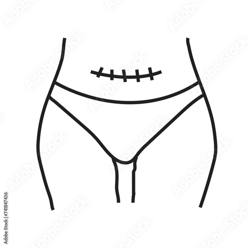 Transverse incision line icon. Abdominal incisions. Scars line icon in vector, c-section scar illustration