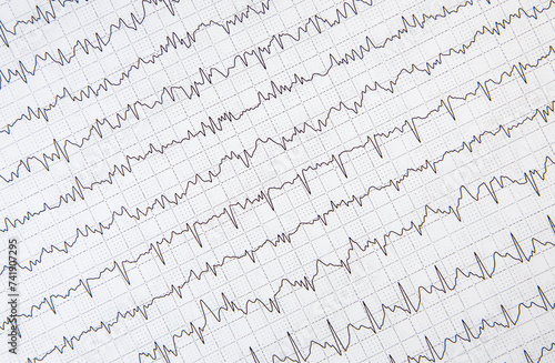 Foto ECG electrocardiogram of a cardiac person, heart disease
