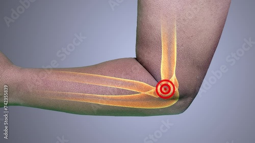 Tennis elbow carpal tunnel syndrome photo