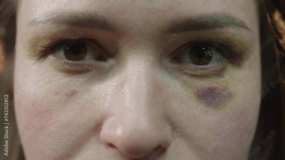 Close up woman portrait with black eye taking off sunglasses Close up woman portrait with black eye taking off sunglasses