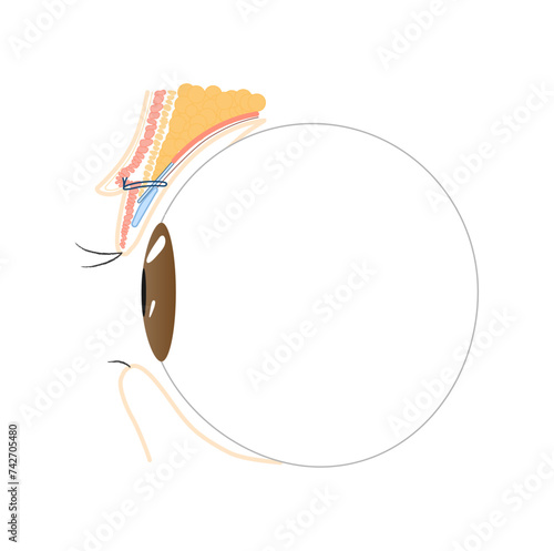 埋没法　二重埋没　二重　一重　瞼　構造　図　二重整形　double plastic surgery　double eyelid　断面図　이중 눈꺼풀　이중 성형　매몰법　目　眼球　
眼瞼挙筋