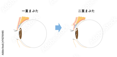 二重　一重　瞼　構造　図　二重整形　double plastic surgery　double eyelid　断面図　이중 눈꺼풀　이중 성형