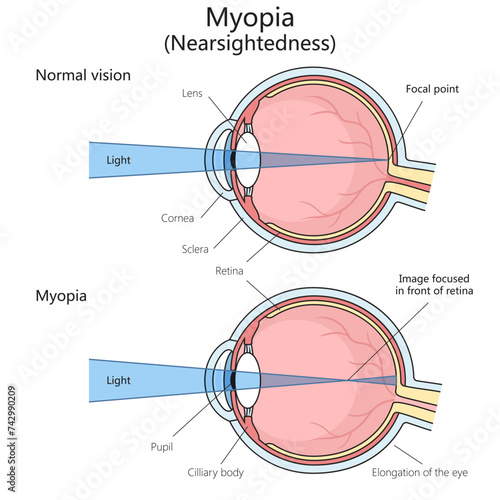 Myopia disorder of vision structure diagram hand drawn schematic vector illustration. Medical science educational illustration