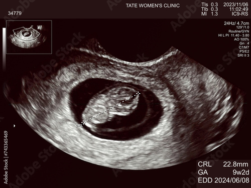 妊娠9週目の胎児エコー写真