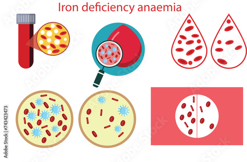Iron deficiency anaemia,reduction in the number of red blood cells,Iron deficiency anemia.The difference of Anemia amount of red blood cell and normal,Anemia and Hemophilia icon.,five vectors