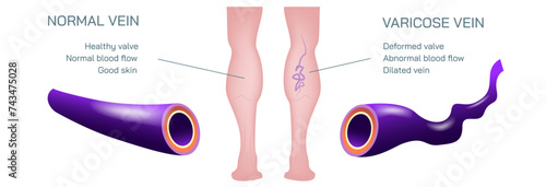Varicose veins are bulging, enlarged veins or varicosities vector illustration. Hemorrhoids cause aching pain and discomfort or signal an underlying circulatory problem.