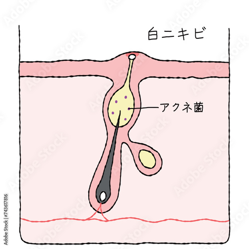 ニキビの構造　白ニキビ
