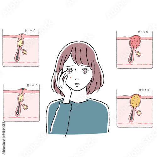 ニキビの構造と女性