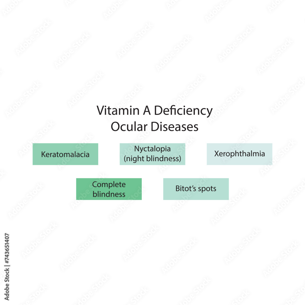 Diagram showing Vitamin A deficiency related ocular diseases