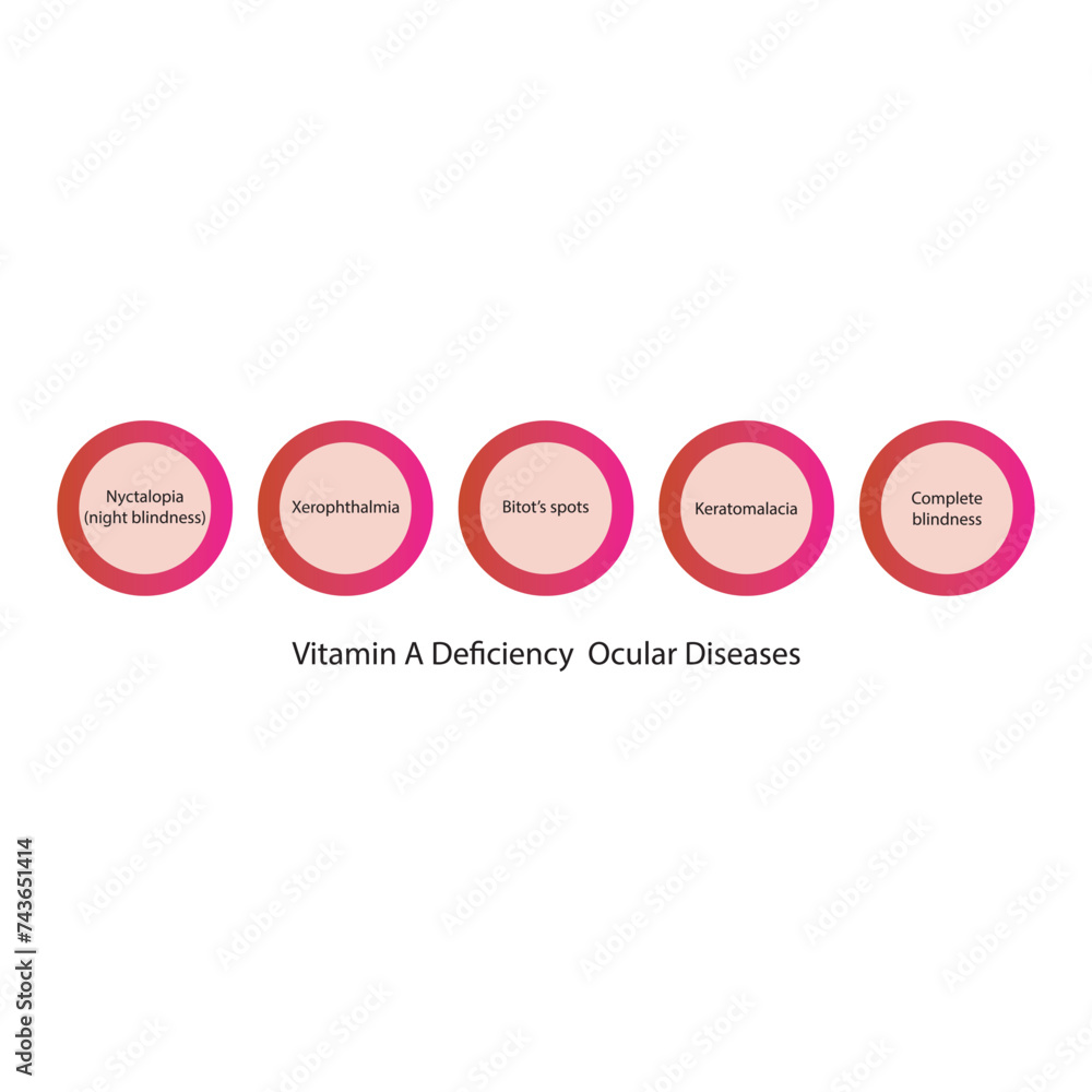 Diagram showing Vitamin A deficiency related ocular diseases