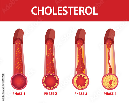 Cholesterol in artery, health risk ,  Vector illustration.