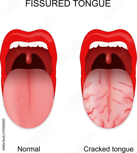 Fissured tongue. Healthy and cracked tongue