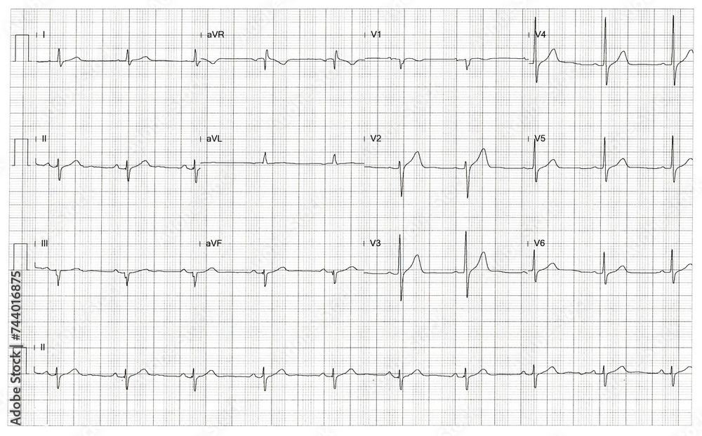 Rhythm of heart on graph using for fetal heart monitoring Rhythm of heart on graph using for fetal heart monitoring