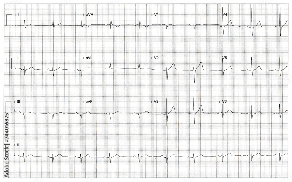 Rhythm of heart on graph using for fetal heart monitoring