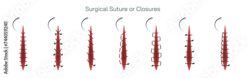 Types of surgical sutures vector illustration. Suture are used by your doctor to close wounds to your skin or other tissues. Thread is attached to a needle to stitch the wound shut.