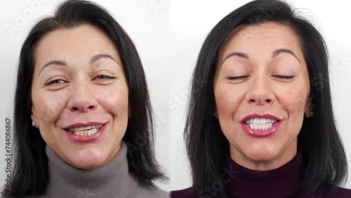 Woman before and after zirconia veneers, dental ceramic crowns. Female patient talk to camera before and after porcelain veneers. Smile makeover with dental veneers, before and after in dental clinic.