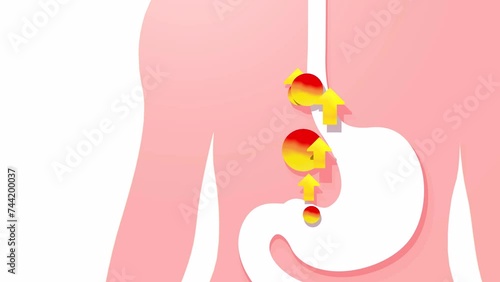 3d animation of esophagus with gastric reflux and heartburn. With arrows and circles of fire upward. Digestive system and human silhouette on white background. photo