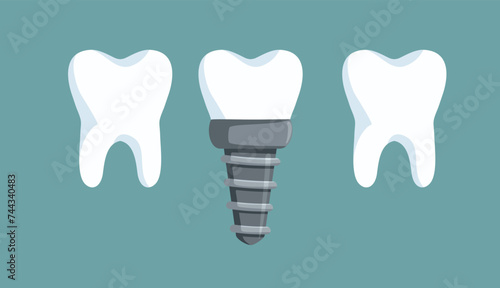Vector Drawing of Tooth Implant in Between other Teeth. Artificial tooth replacement in orthodontic dental treatment 
