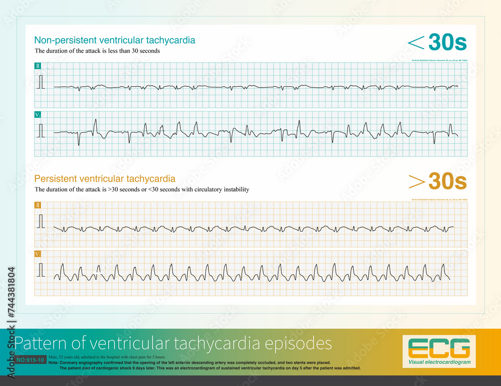 When the duration of a ventricular tachycardia attack exceeds 30