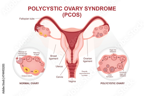 Polycystic Ovary Syndrome (PCOs) Cross sections illustration educational