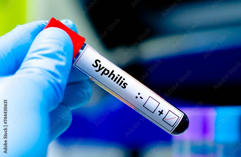 Blood sample of patient positive tested for syphilis. Blood sample of patient positive tested for syphilis.