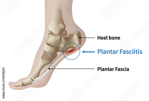 Foot anatomy medical illustration showing plantar fasciitis