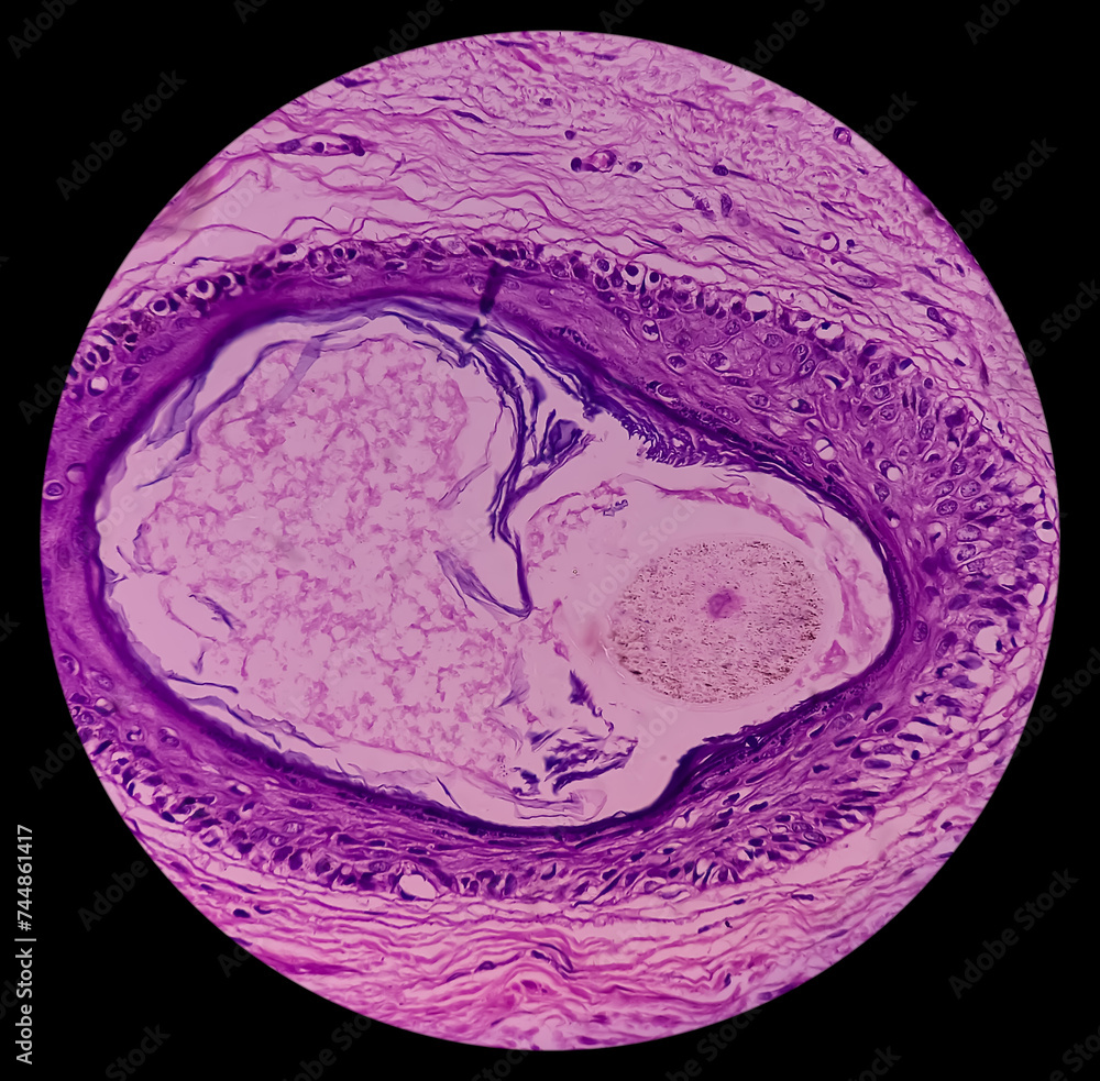 Mature cystic teratoma, Ovarian cyst biopsy, show cyst wall of skin and ...