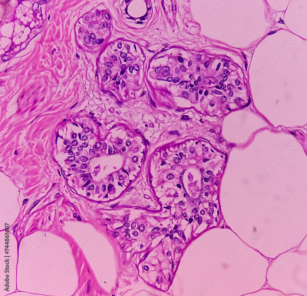 Mature cystic teratoma, Ovarian cyst biopsy, show cyst wall of skin and adnexal structure, fatty tissue, salivary acini and cartilage. Cystic teratoma of dermoid cyst. Mature cystic teratoma, Ovarian cyst biopsy, show cyst wall of skin and adnexal structure, fatty tissue, salivary acini and cartilage. Cystic teratoma of dermoid cyst.