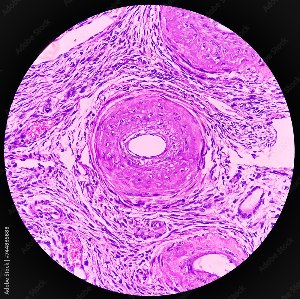 Uterus with adnexa (biopsy): Cervix show chronic inflamatory cells ...