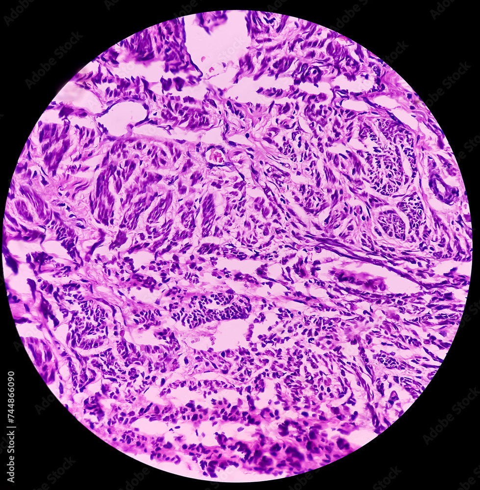 Uterus with adnexa (biopsy): Cervix show chronic inflamatory cells ...