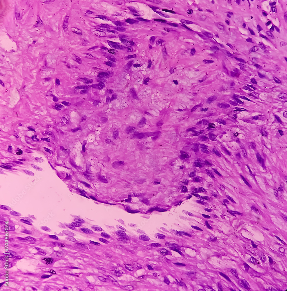 Swelling of middle finger (biopsy). Lobular Capillary hemangioma. A ...