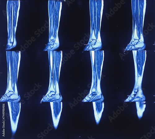 Tableau sur toile MRI (Magnetic resonance imaging) scan of leg