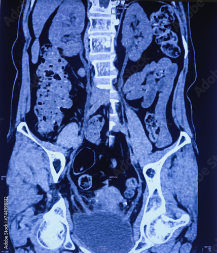 CT scan of KUB (non-contrast): Left renal tiny calculi (without obstructive feature). Kidney stone. photo