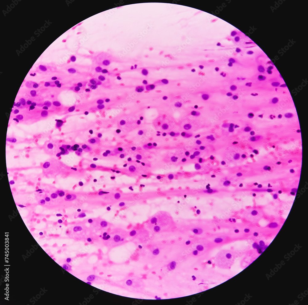 FNA cytology of swelling of chest wall. Infected epidermal inclusion cyst. Commonly called FNA cytology of swelling of chest wall. Infected epidermal inclusion cyst. Commonly called
